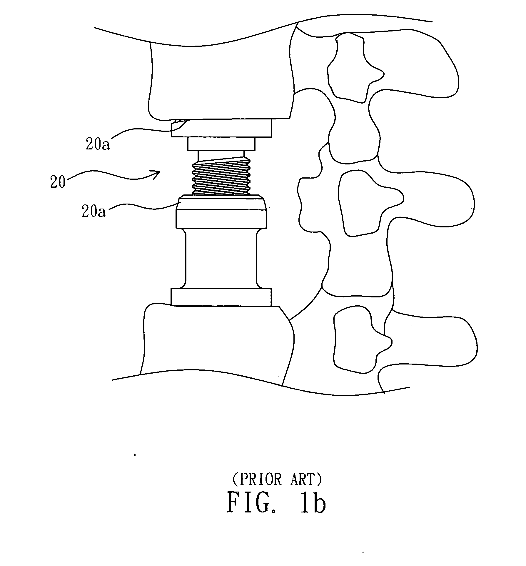 Adjustable vertebral spacer for artificial vertebrae