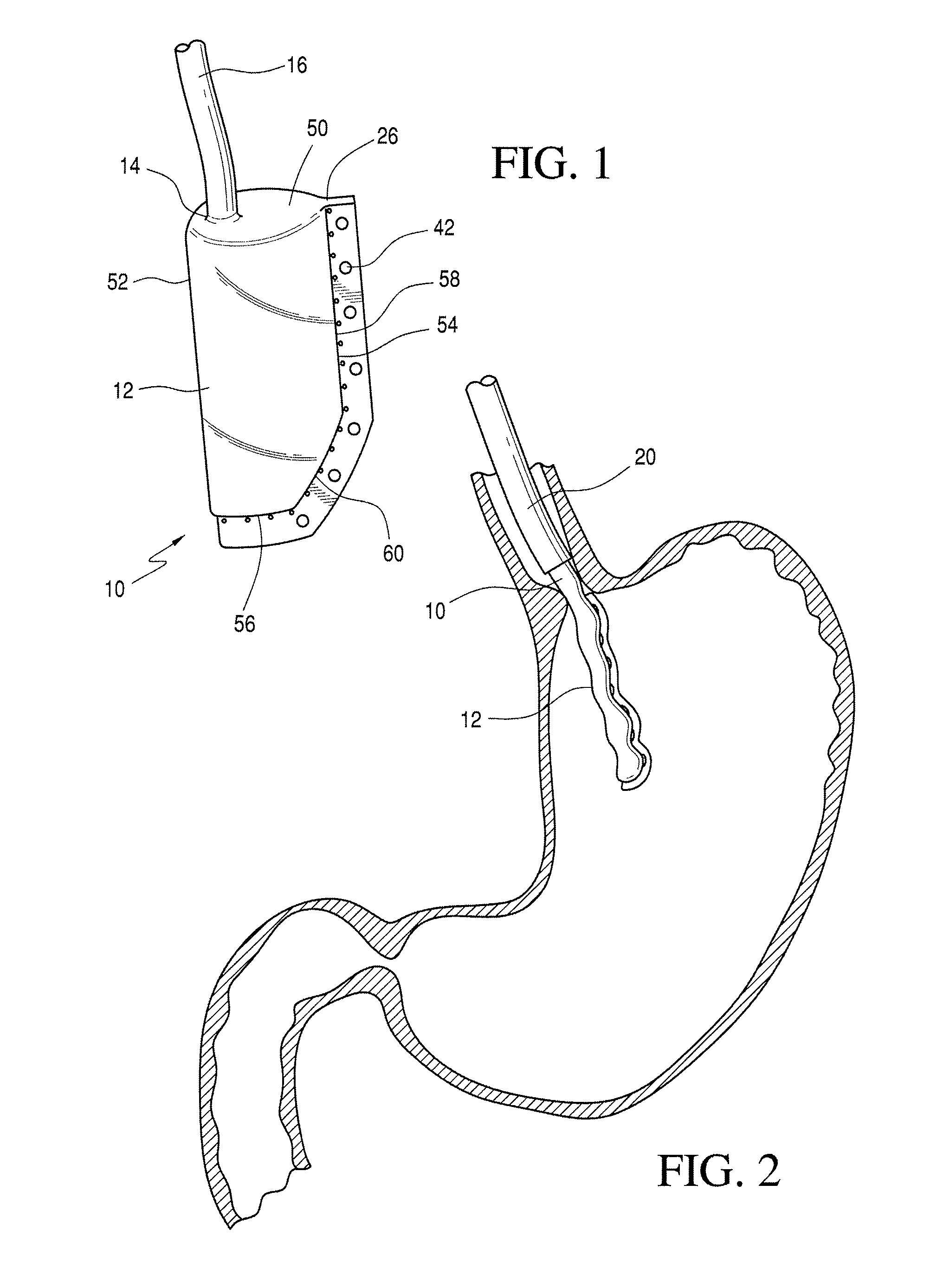 Method and apparatus for marking a lumenal wall