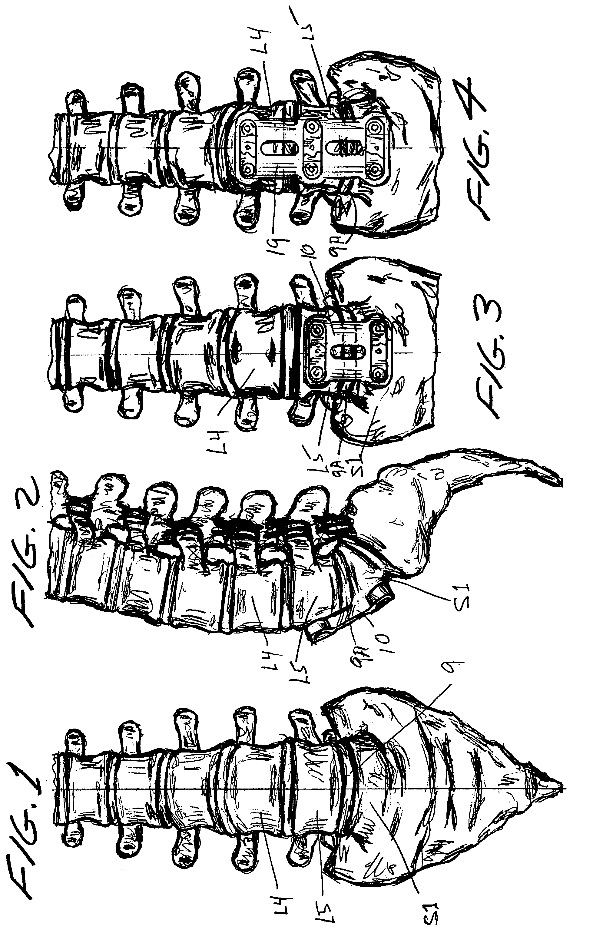 Anterior lumbar lag plate