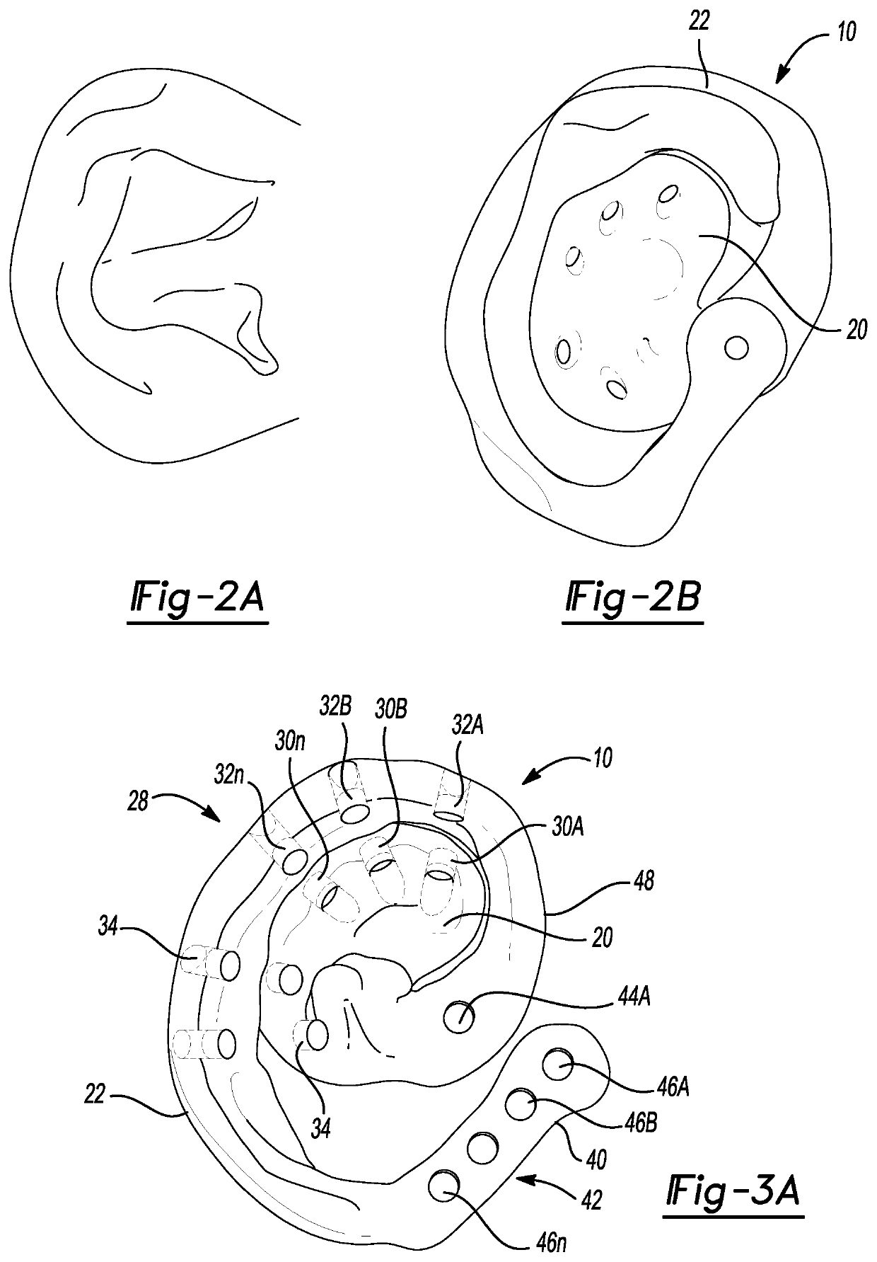 Ear splint to correct congenital ear deformities