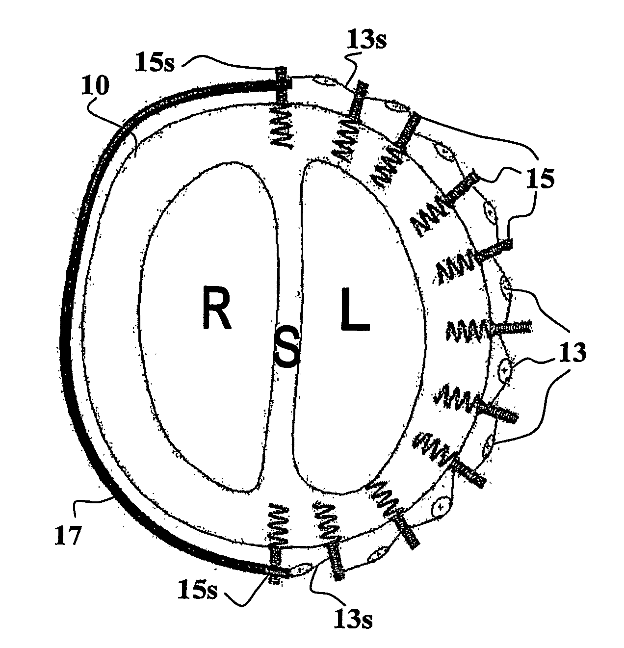 Method and system for improving diastolic function of the heart