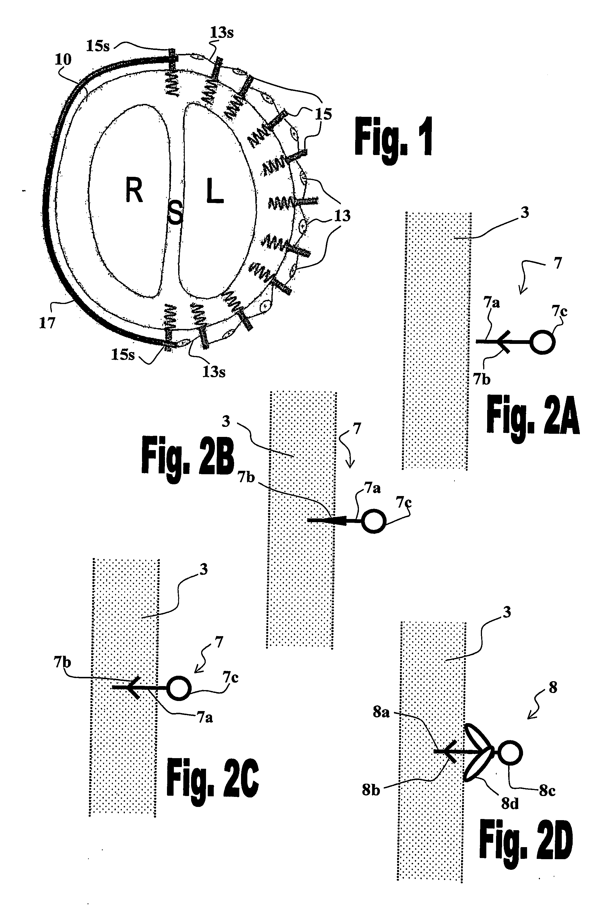 Method and system for improving diastolic function of the heart