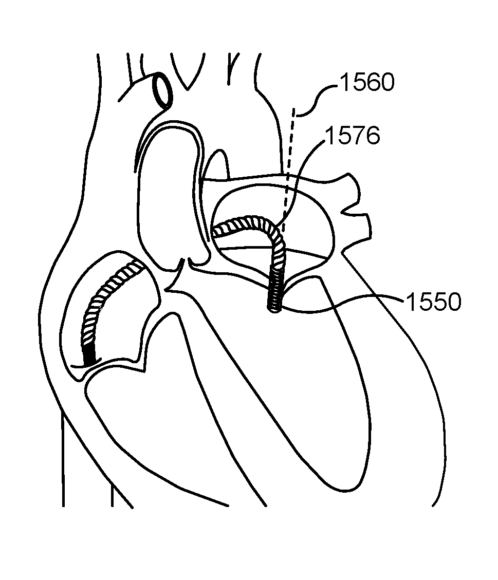 Lateral articulation anchors for catheters and other uses