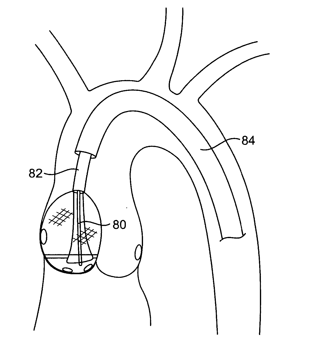 Aortic valve repair