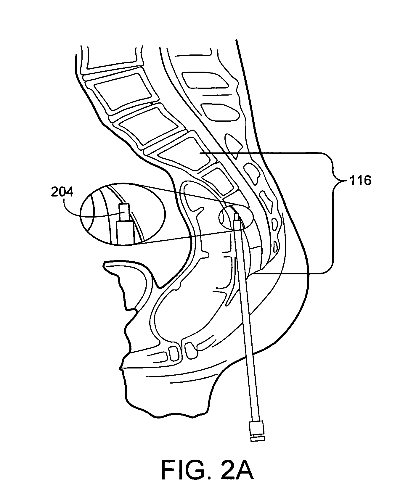 Driver assembly for simultaneous axial delivery of spinal implants