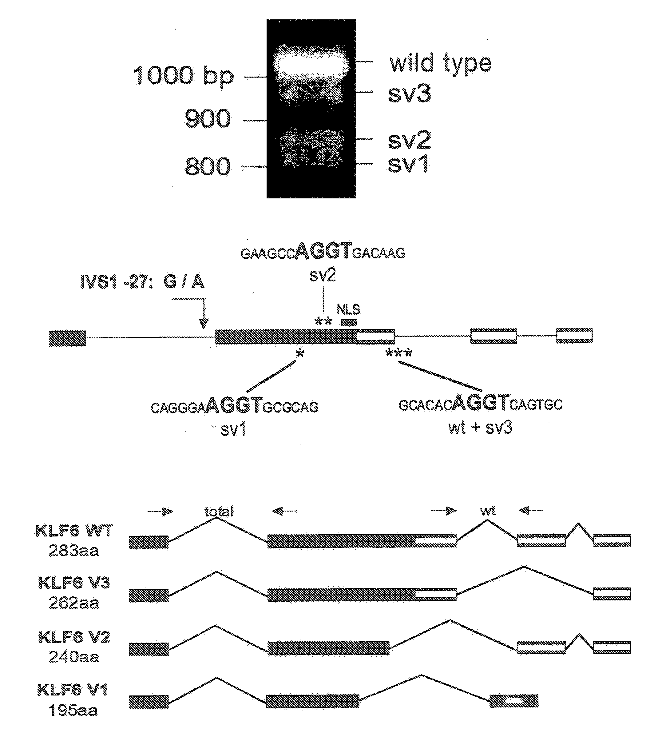 Klf6 alternative splice forms and a germline klf6 DNA polymorphism associated with increased cancer risk