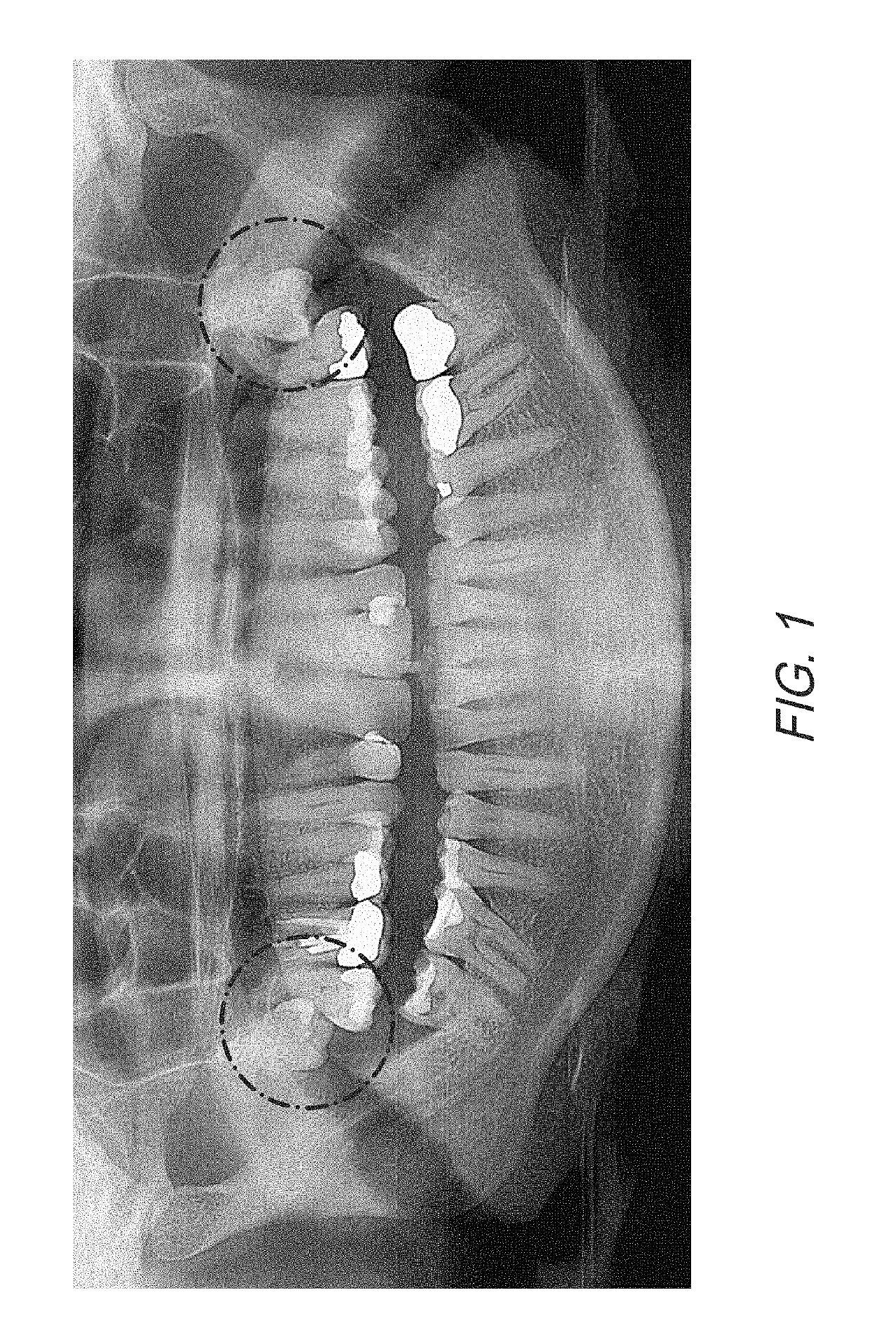 Therapeutic tooth bud ablation