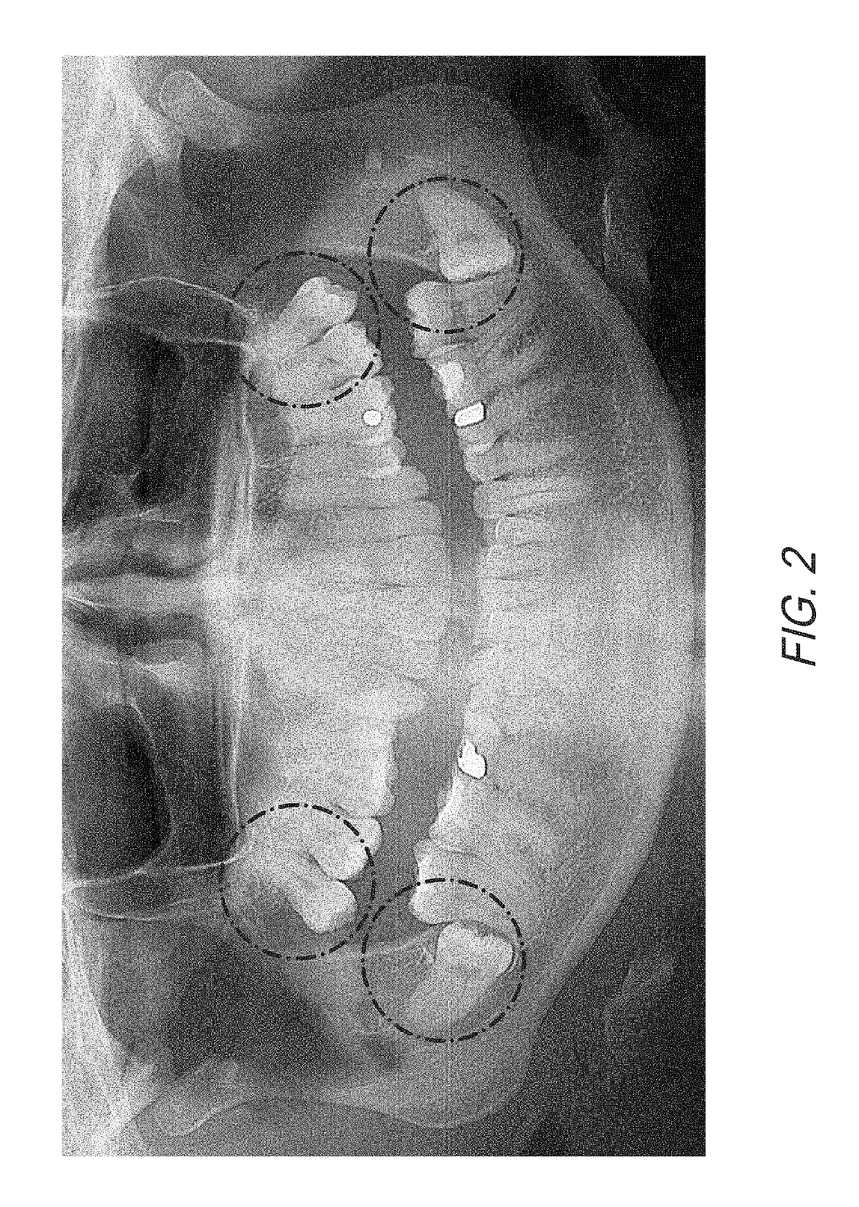 Therapeutic tooth bud ablation