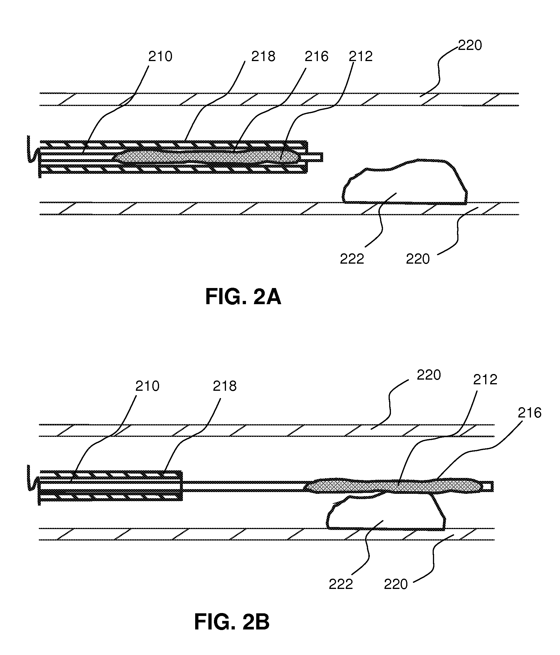 Local delivery of water-soluble or water-insoluble therapeutic agents to the surface of body lumens