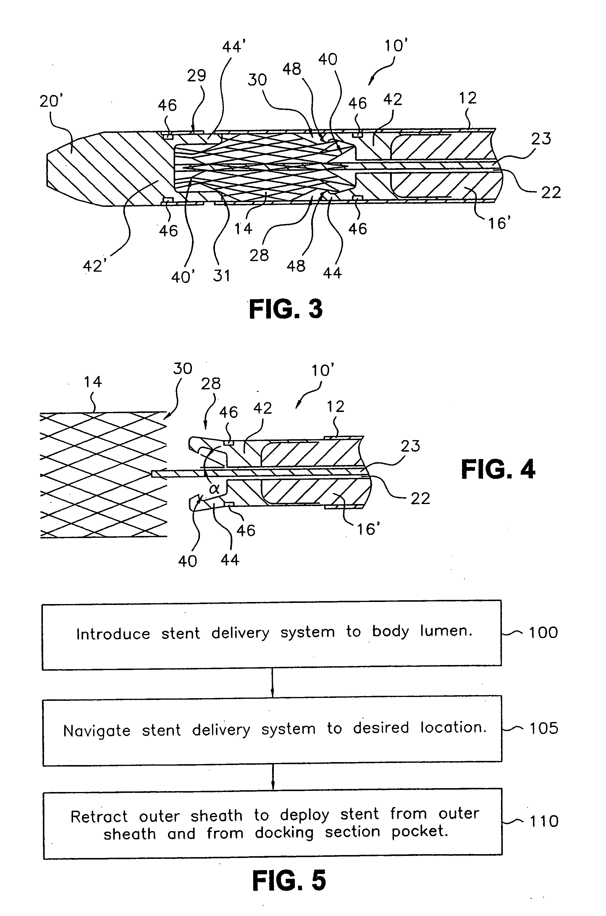 Delivery system for endoluminal implant