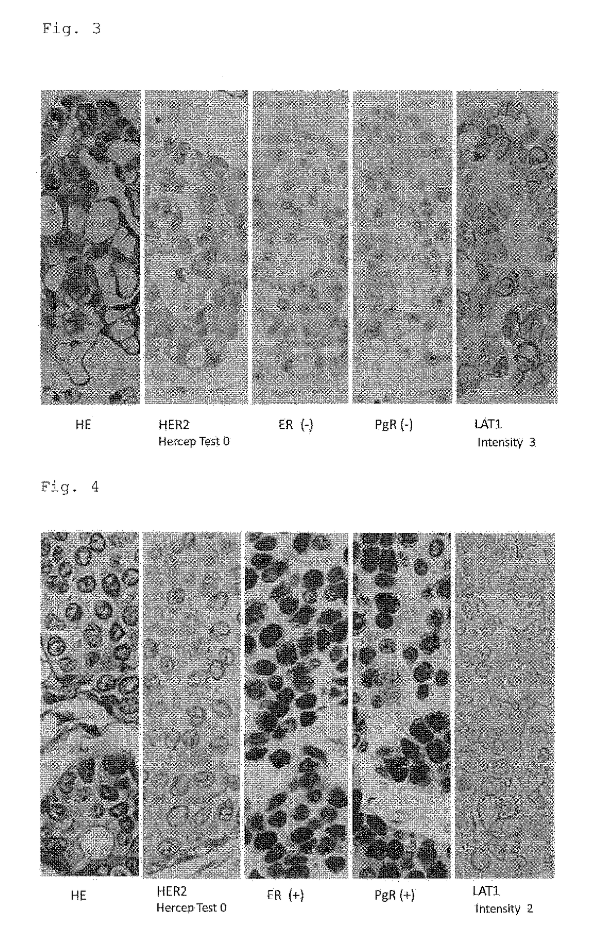 Biomarker for breast cancer