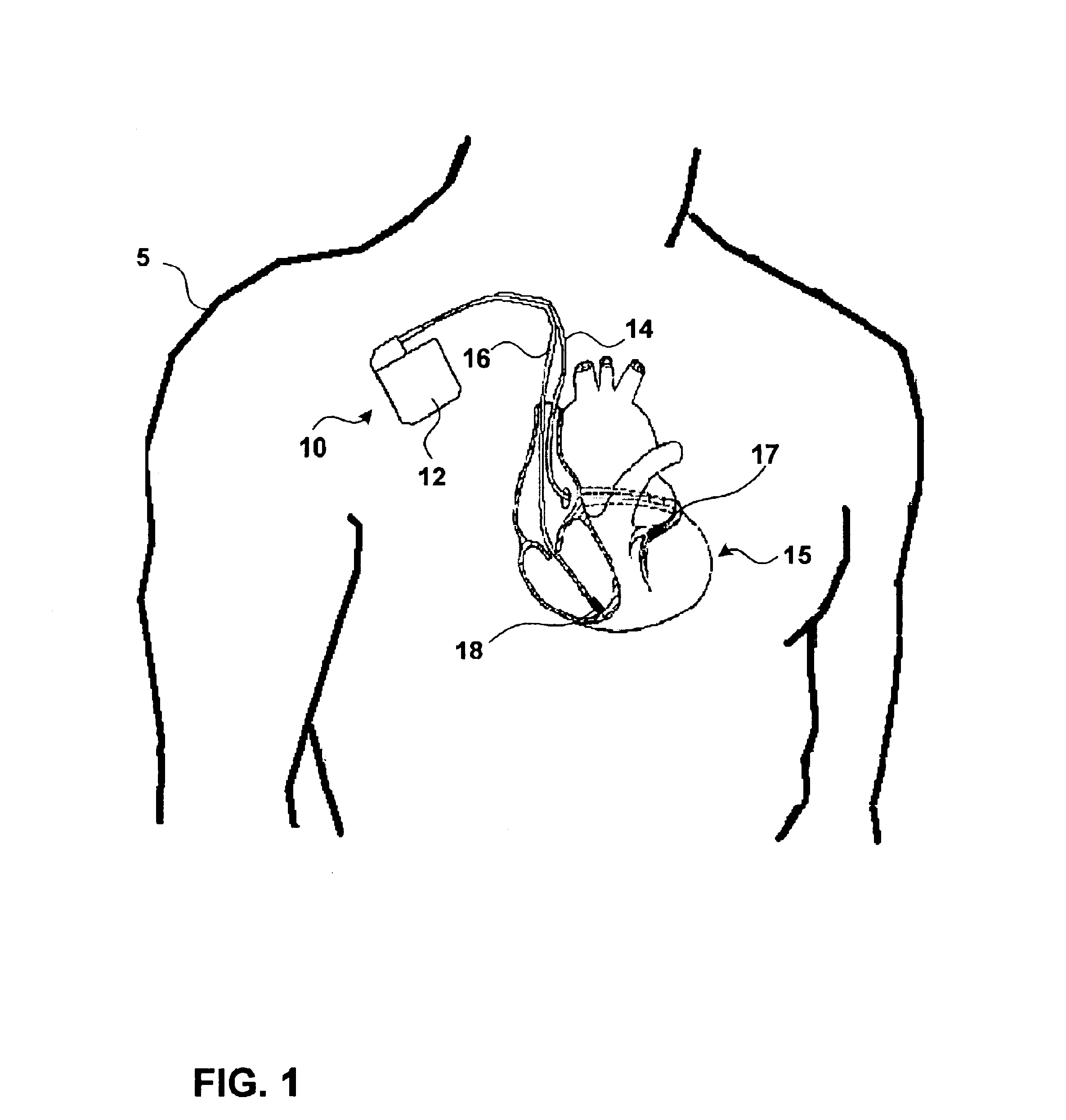 Detecting heart tones to identify heart deterioration