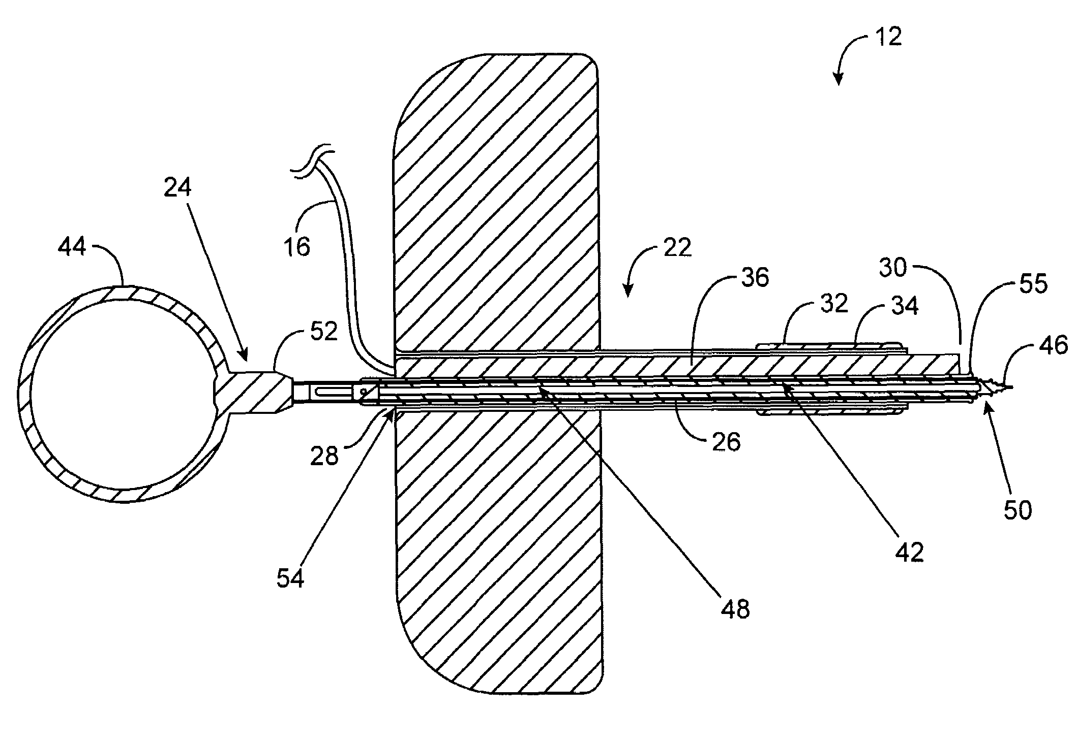 Mechanically registered videoscopic myringotomy/tympanostomy tube placement system