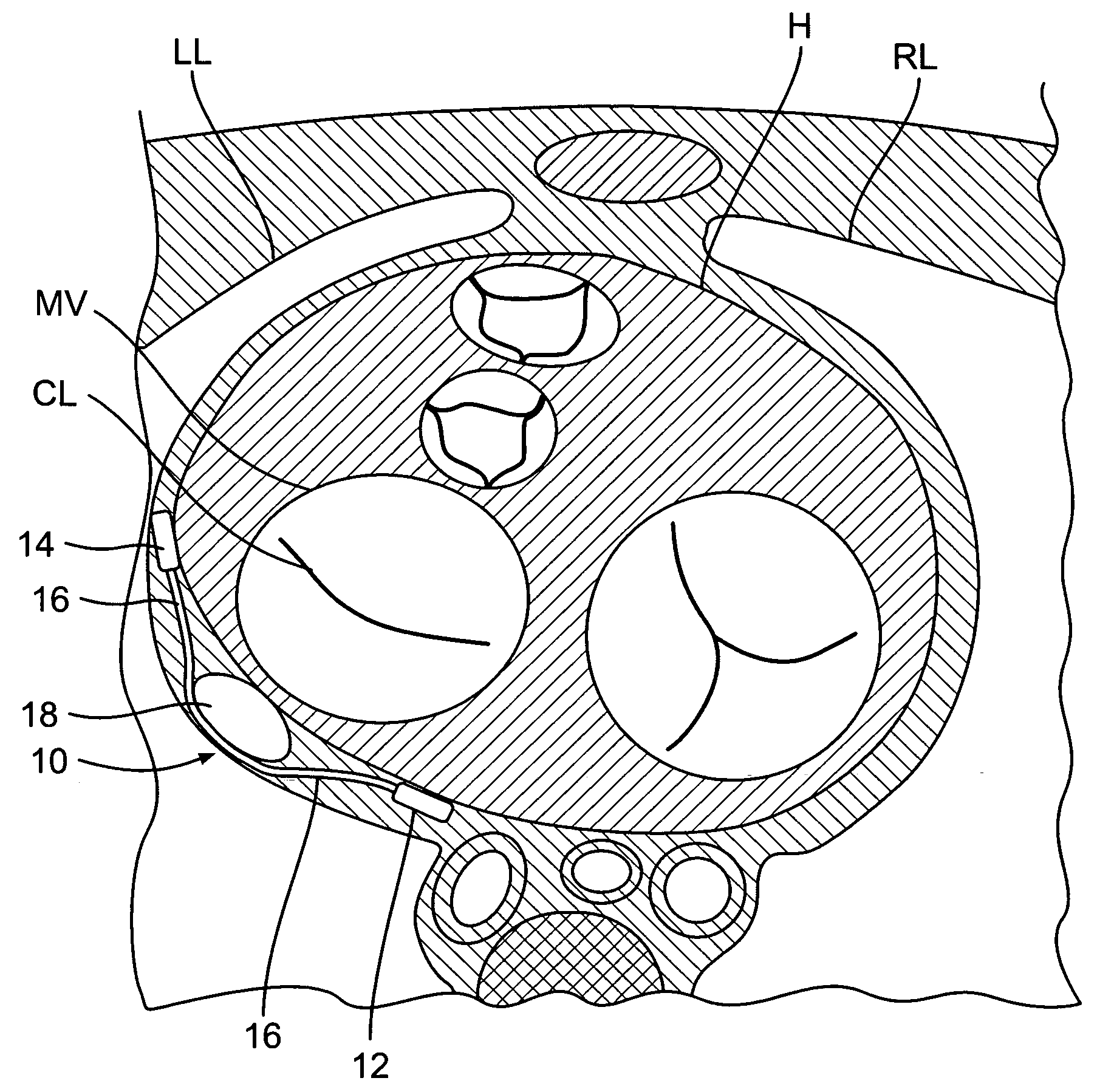 Devices and methods for heart valve treatment