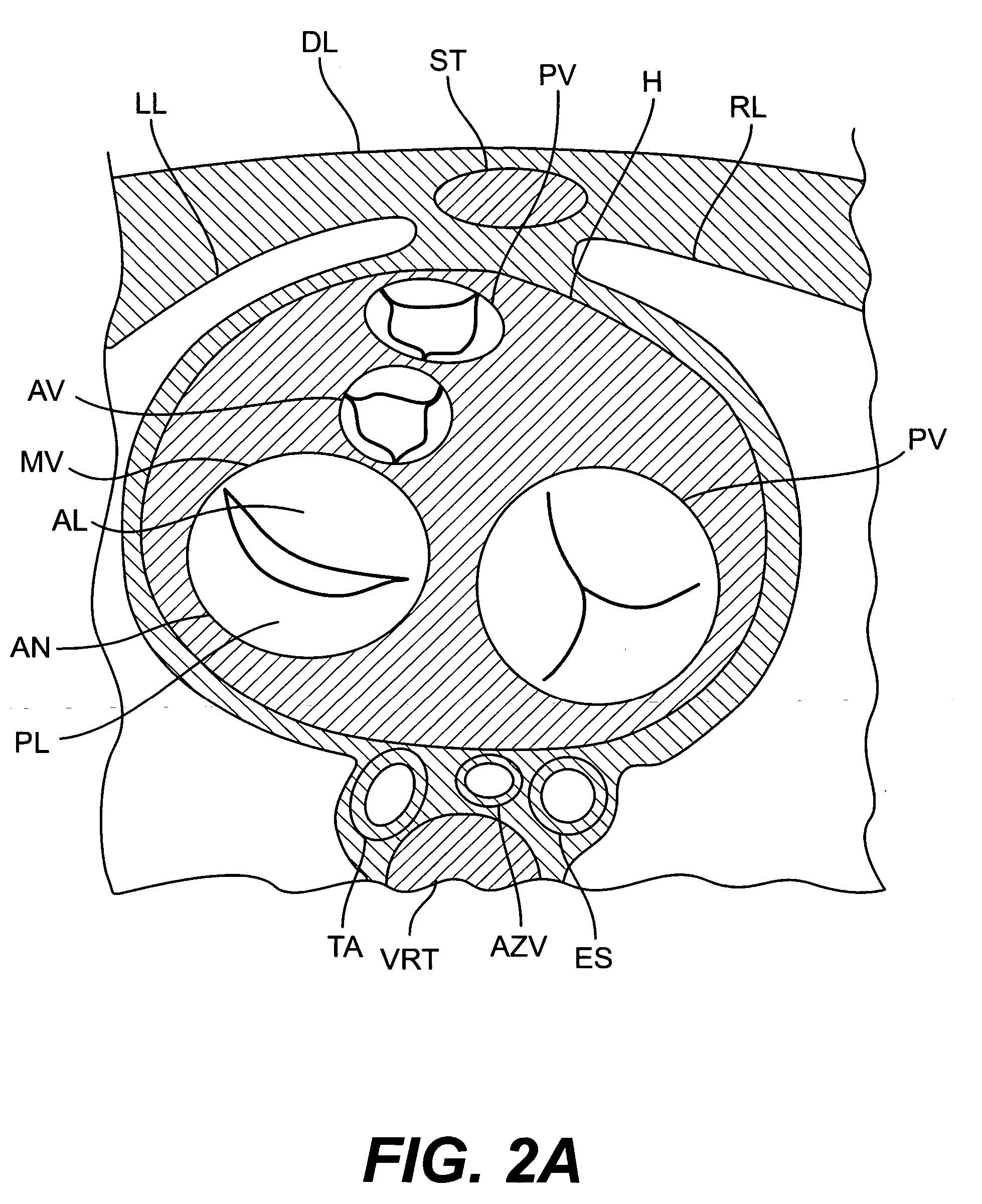 Devices and methods for heart valve treatment