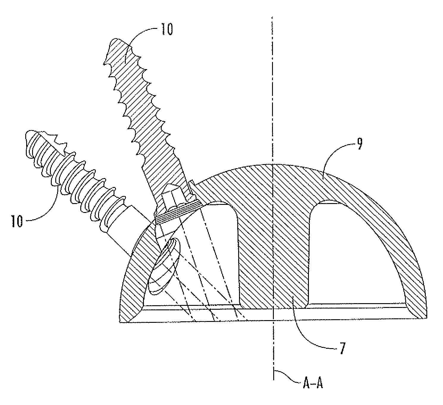 Interlocking acetabular fixation screws and their combination with a reverse hip acetabular cup