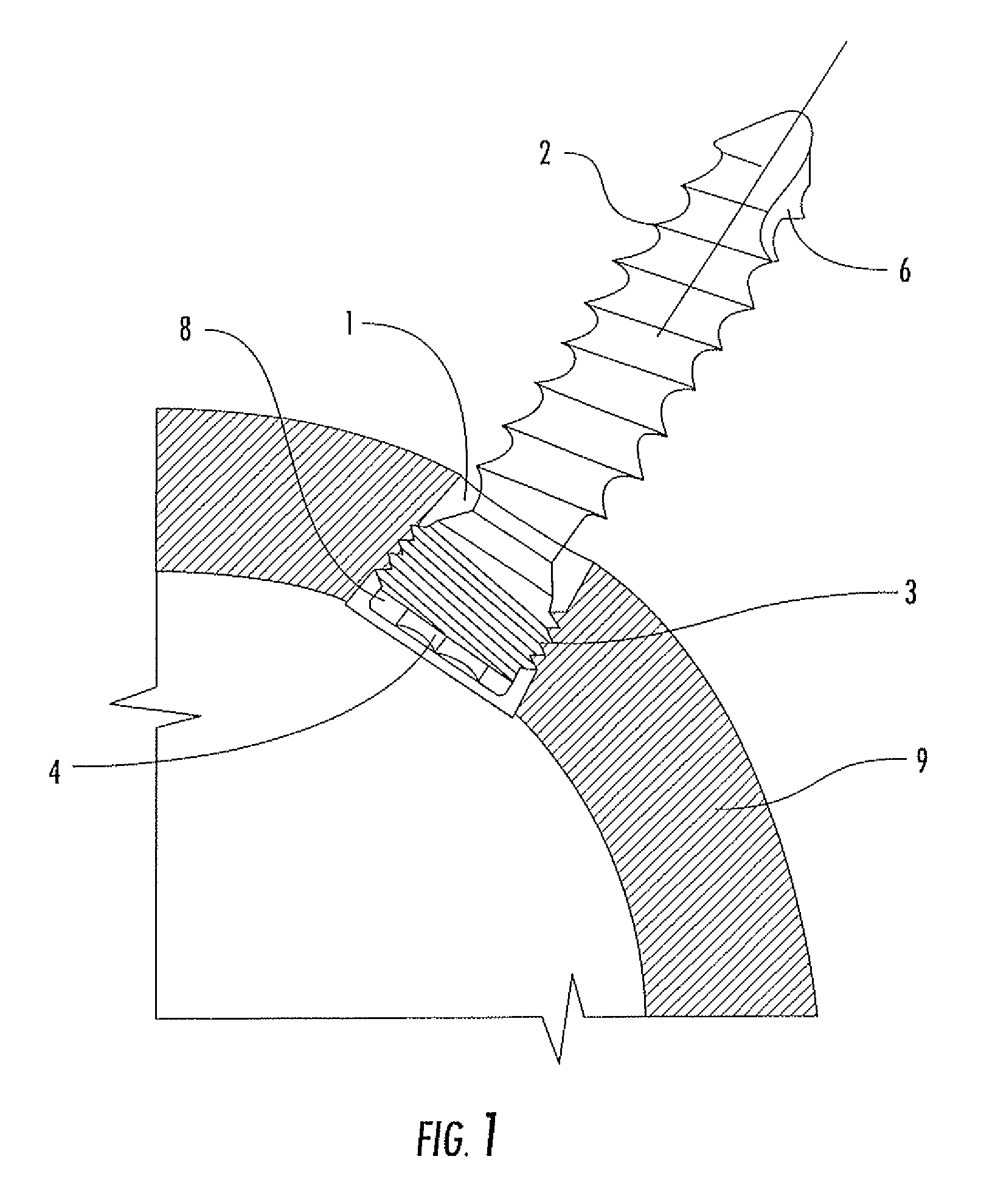 Interlocking acetabular fixation screws and their combination with a reverse hip acetabular cup