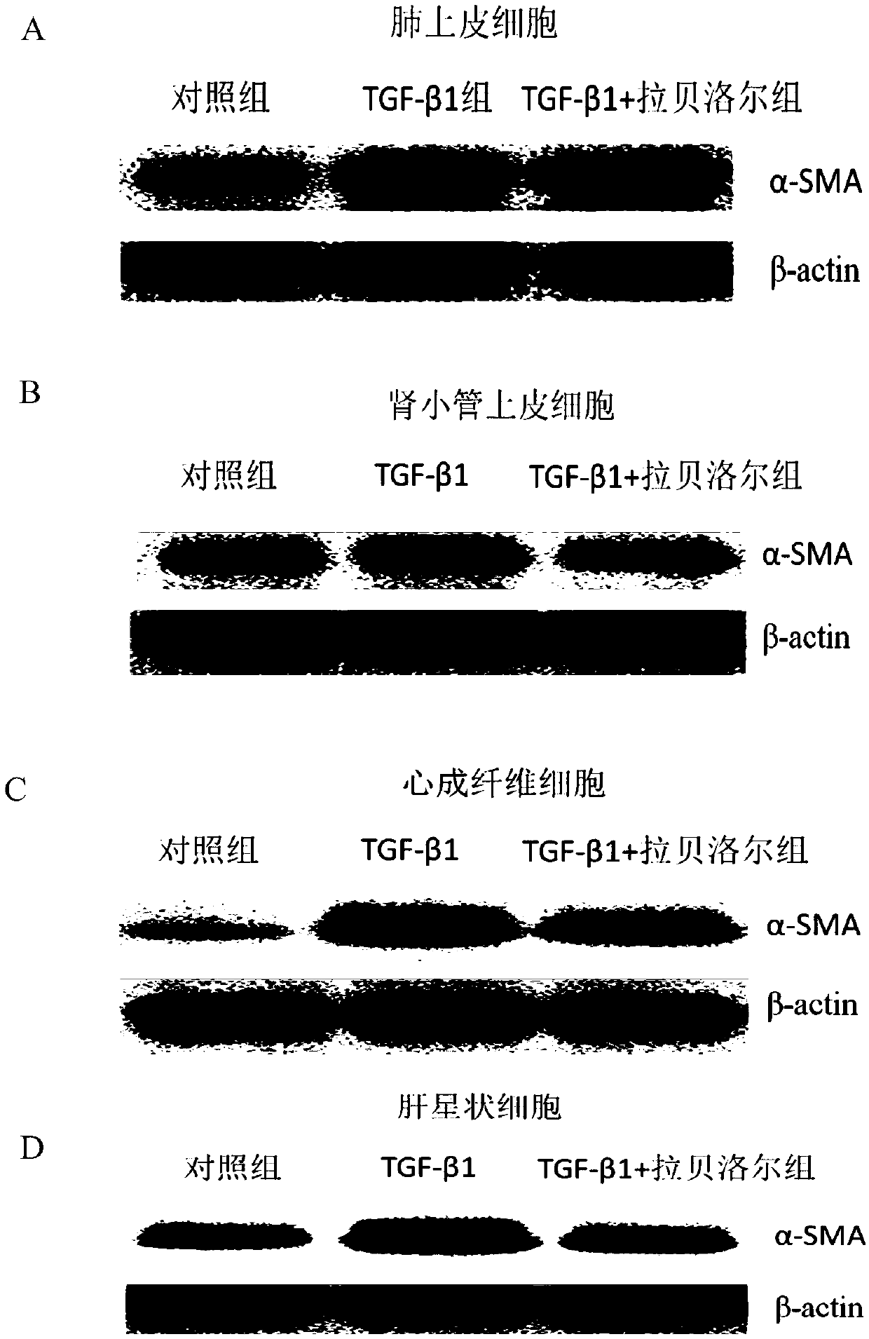 Application of labetalol in preparation of medicine for preventing and treating fibrotic diseases