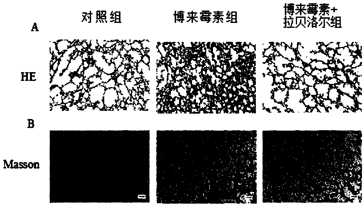 Application of labetalol in preparation of medicine for preventing and treating fibrotic diseases