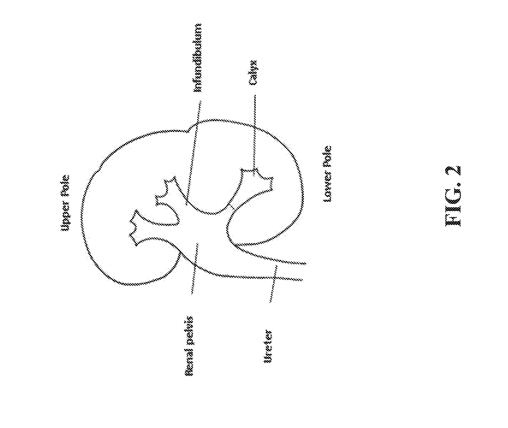 Method and System for Interactive 3D Scope Placement and Measurements for Kidney Stone Removal Procedure