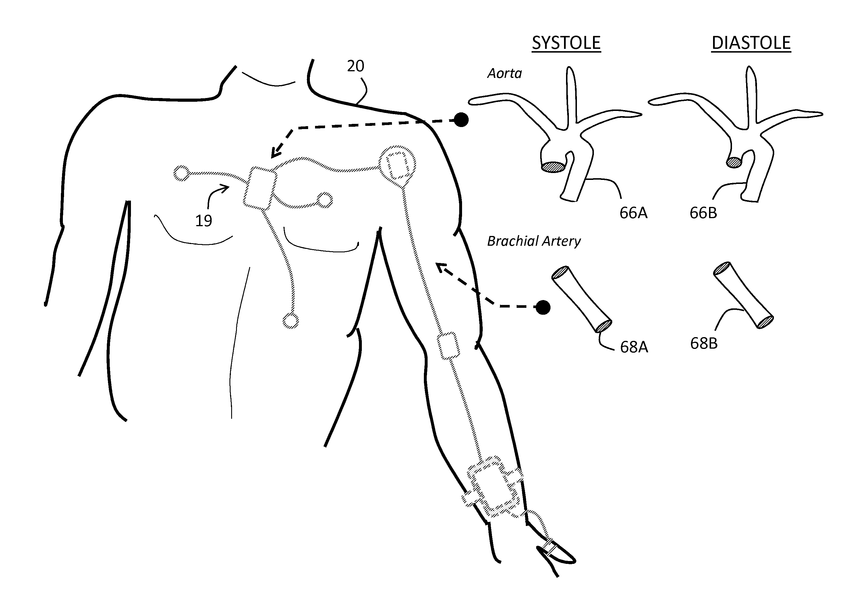 Body-worn system for continuous, noninvasive measurement of cardiac output, stroke volume, cardiac power, and blood pressure