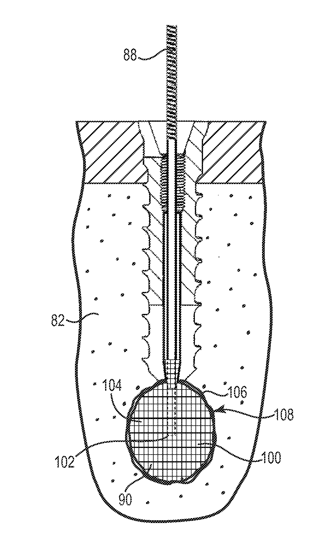 Fixation System for Orthopedic Devices