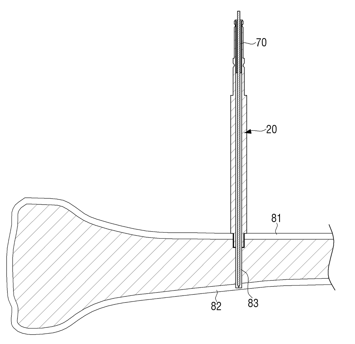 Fixing pin for orthopedic surgery enabling internal fixation