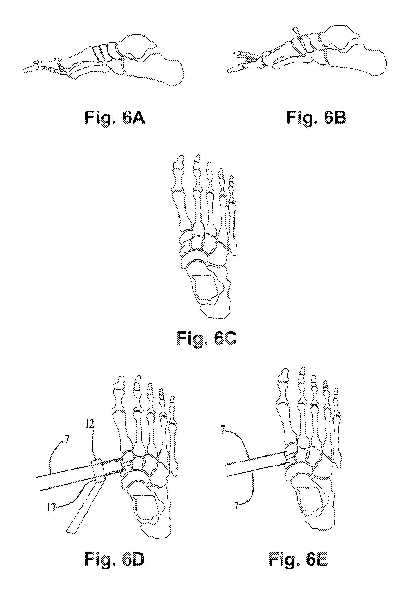 Surgical device, system and method of use thereof