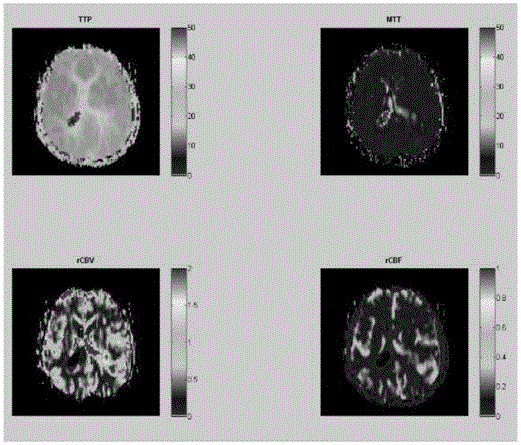 Magnetic resonance perfusion imaging postprocessing method and system thereof