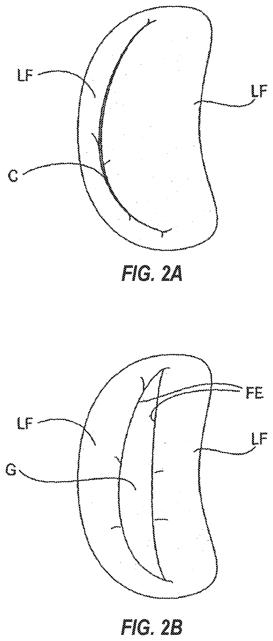 Systems, apparatuses, and methods for removing a medical implant from cardiac tissue