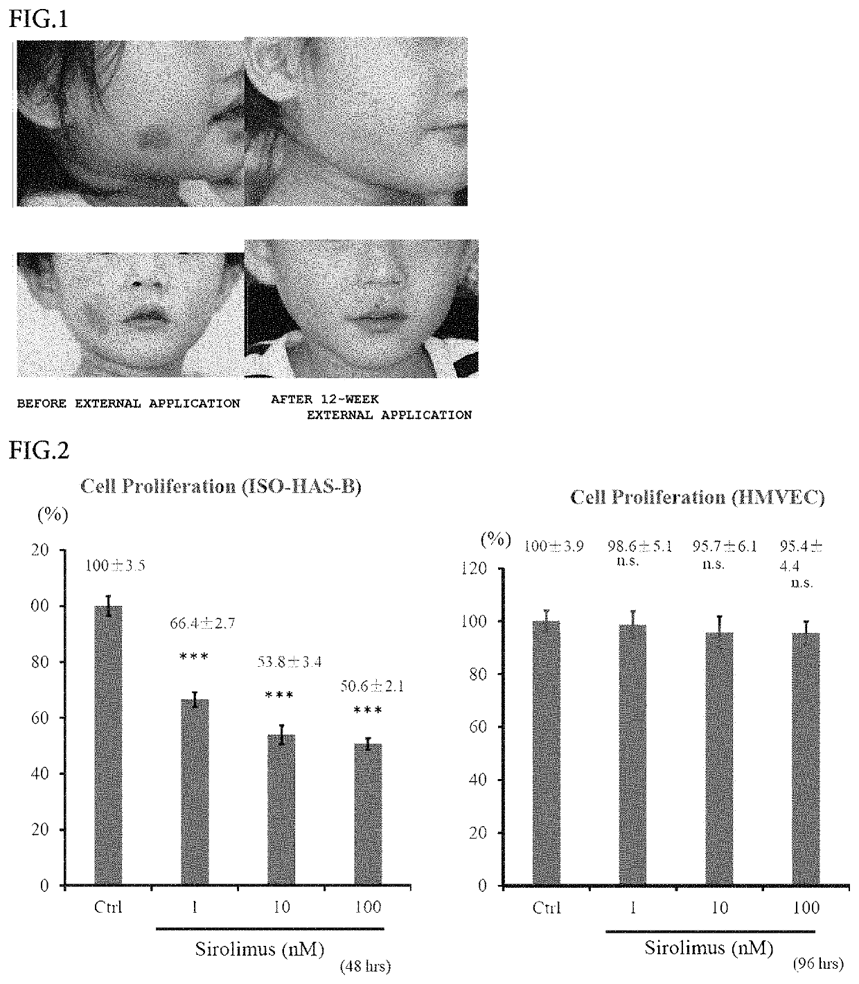 External preparation for treating a vascular anomaly