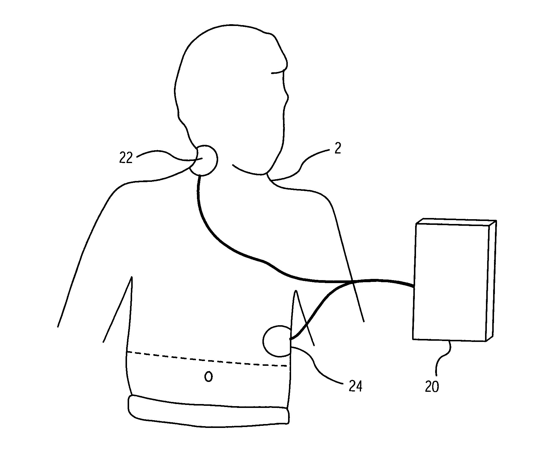 Defibrillation system and method designed for rapid attachment