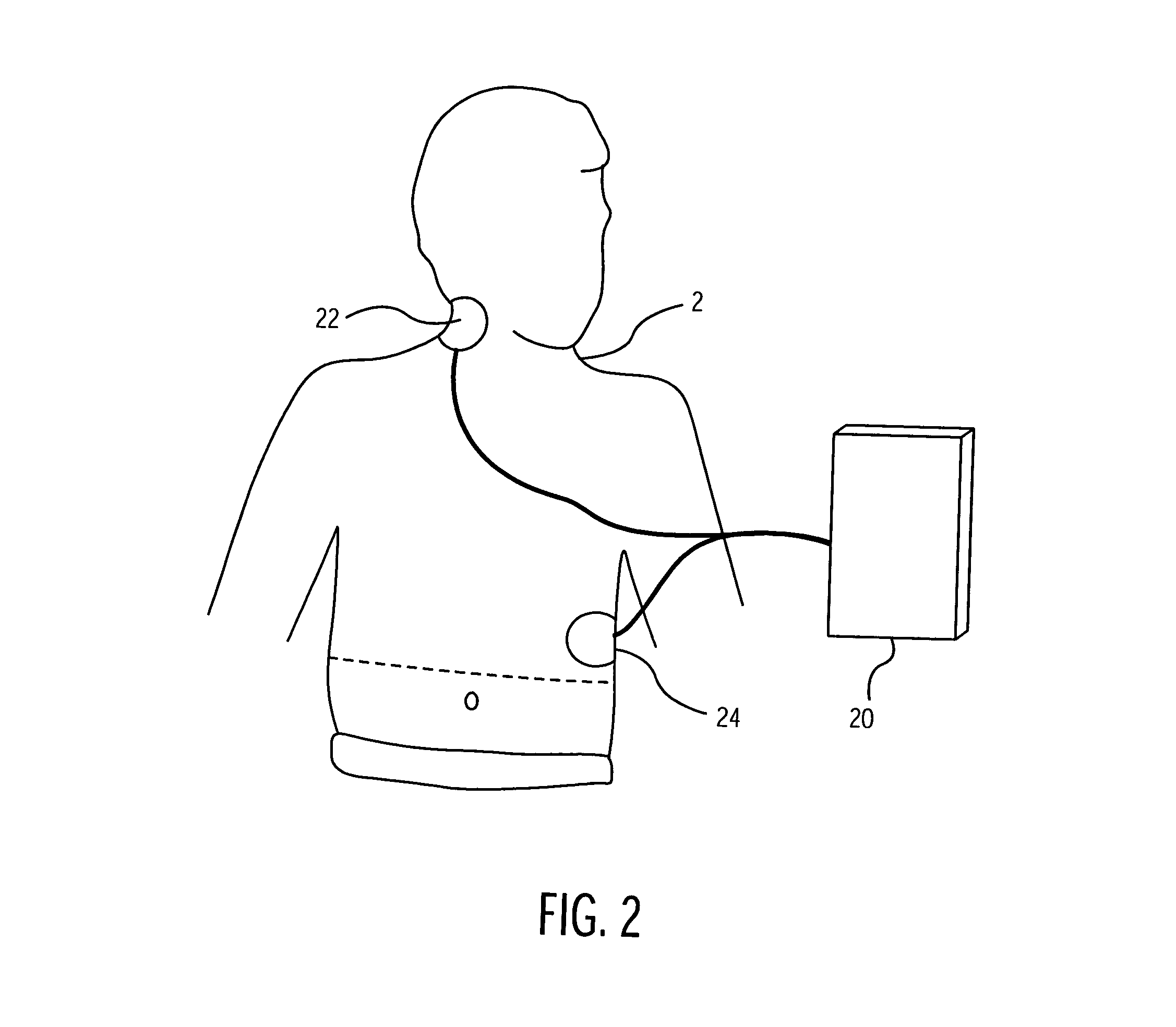 Defibrillation system and method designed for rapid attachment