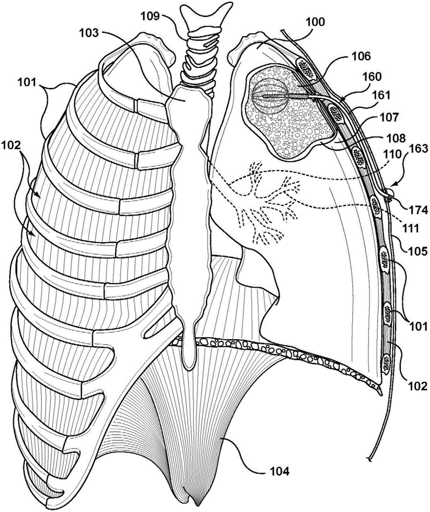 Methods and devices for treating a hyper-inflated lung