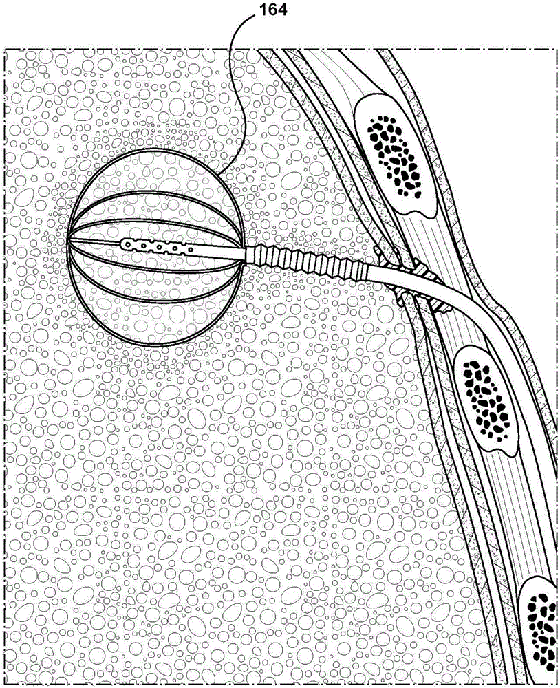 Methods and devices for treating a hyper-inflated lung