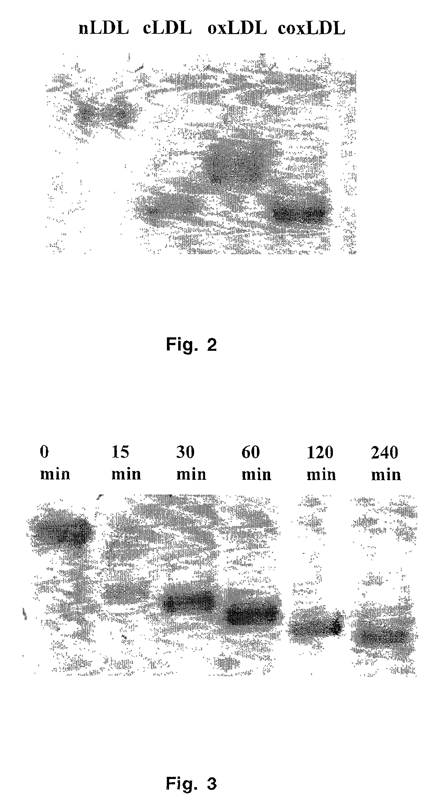 Diagnosing atherosclerosis risk by measuring carbamylated low density lipoprotein levels