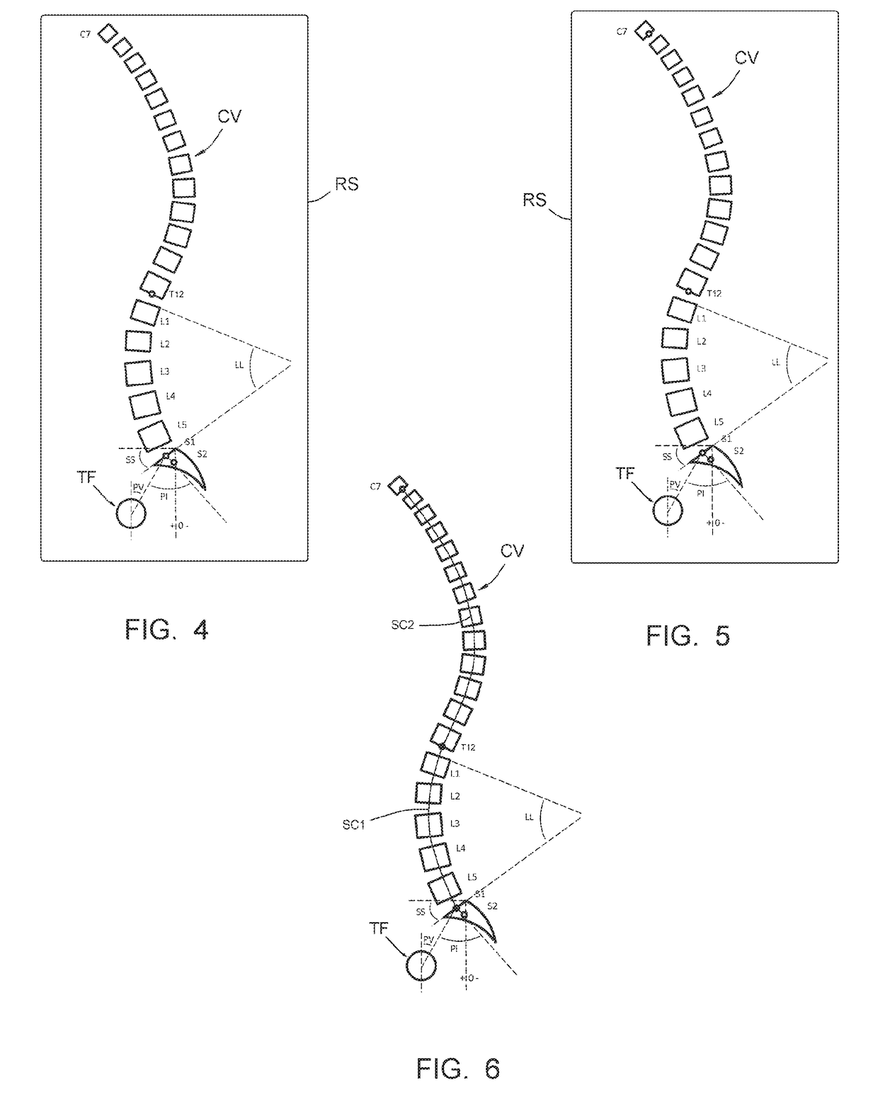 Method making it possible to produce the ideal curvature of a rod of vertebral osteosynthesis material designed to support a patient vertebral column