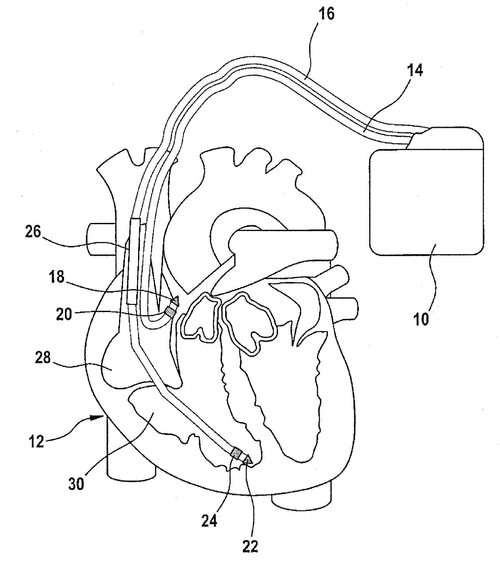 Atrial defibrillator