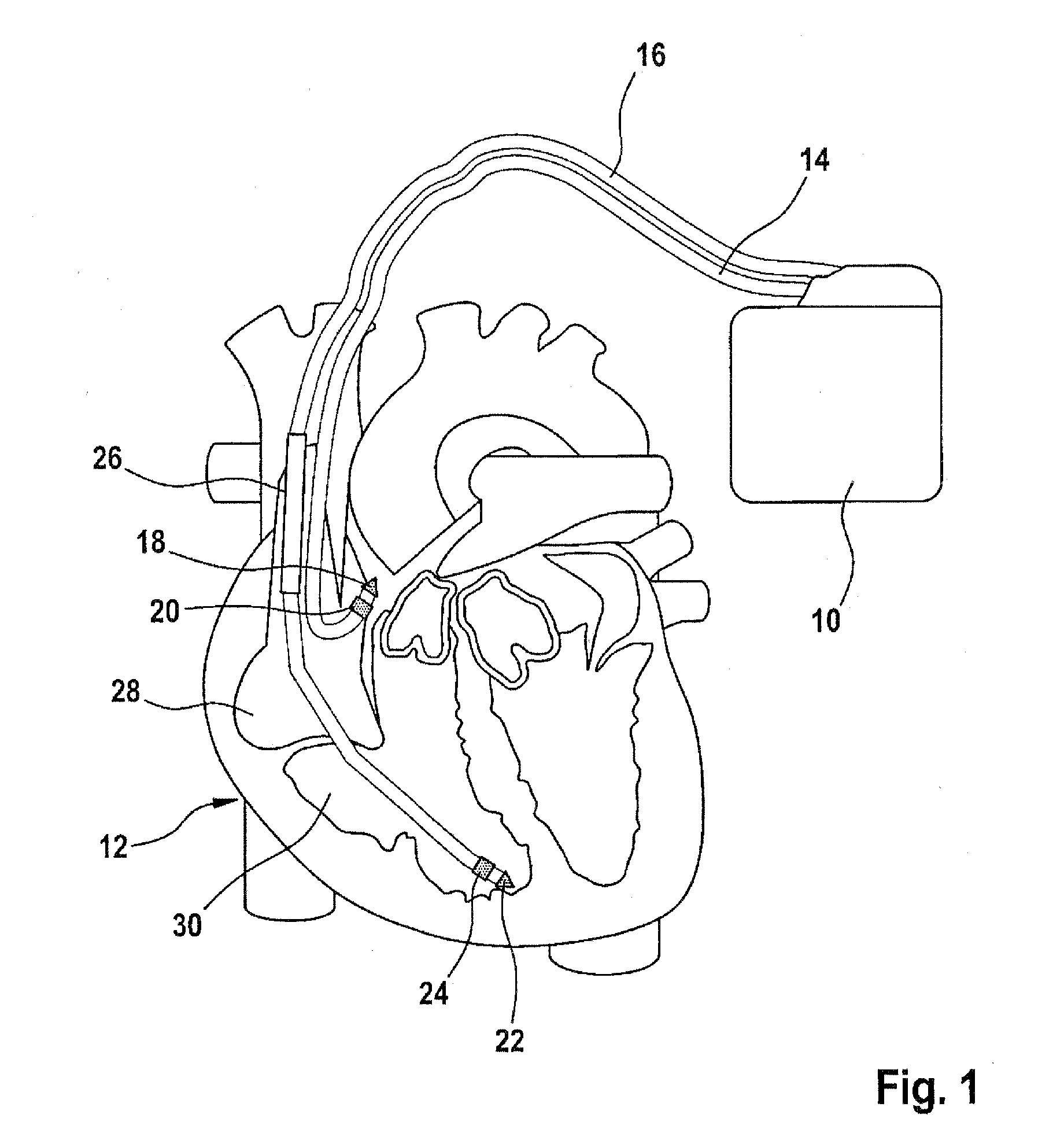 Atrial defibrillator