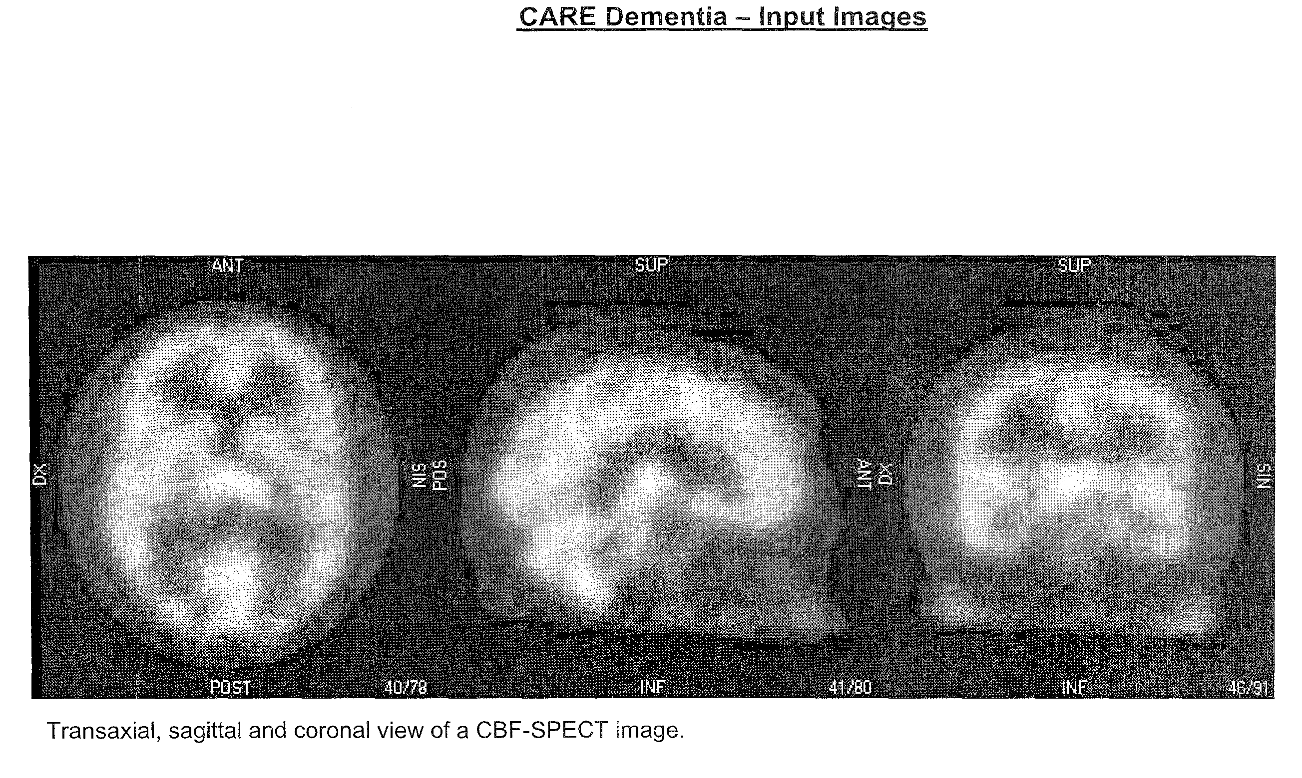 Automatic interpretation of 3-d medicine images of the brain and methods for producing intermediate results