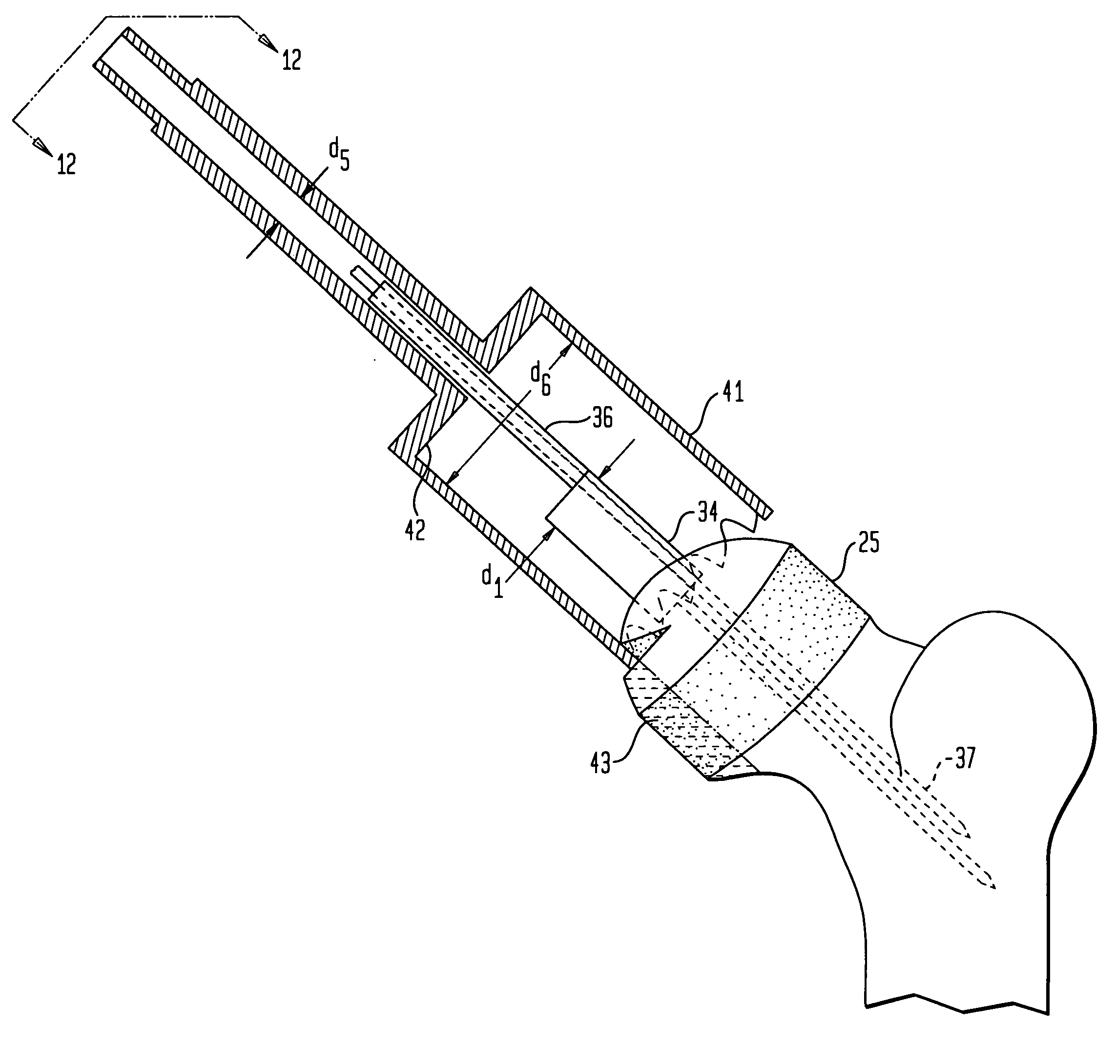 Offset tool guide for femoral head preparation