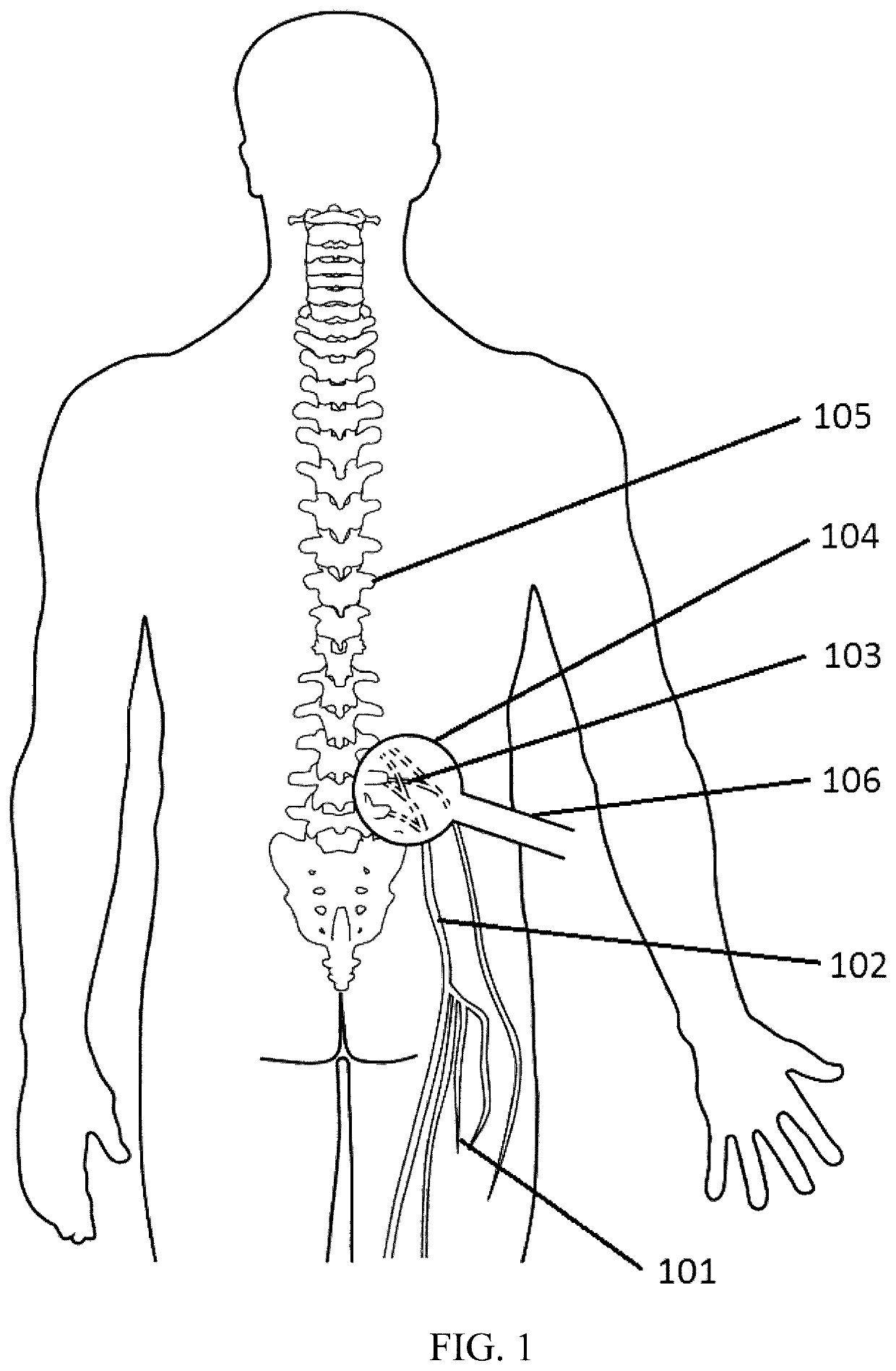 Systems and methods for spasticity treatment using spinal nerve magnetic stimulation