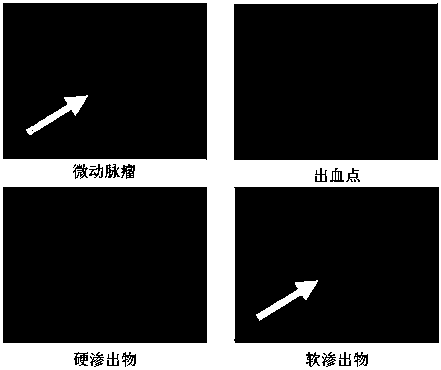 Diabetic retinopathy image labeling method based on deep learning