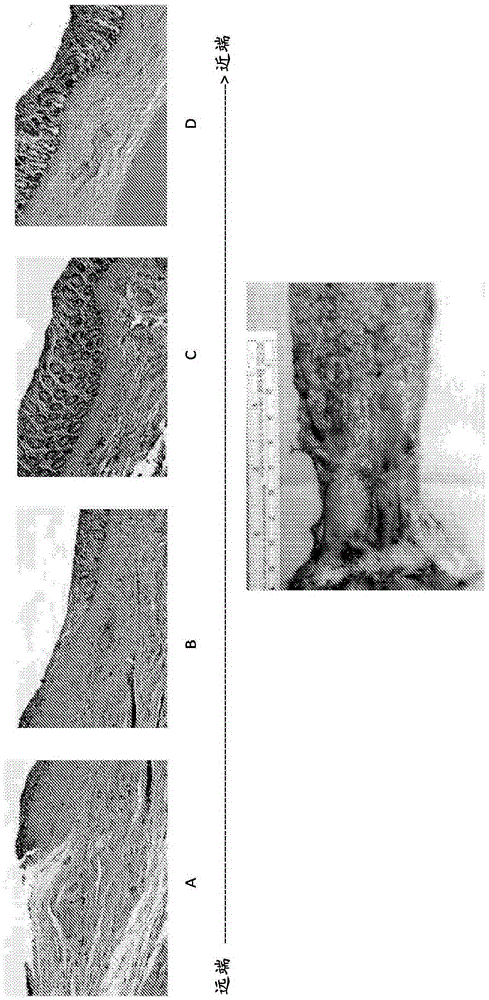 Method and composition for treating inflammatory bowel disease without colectomy