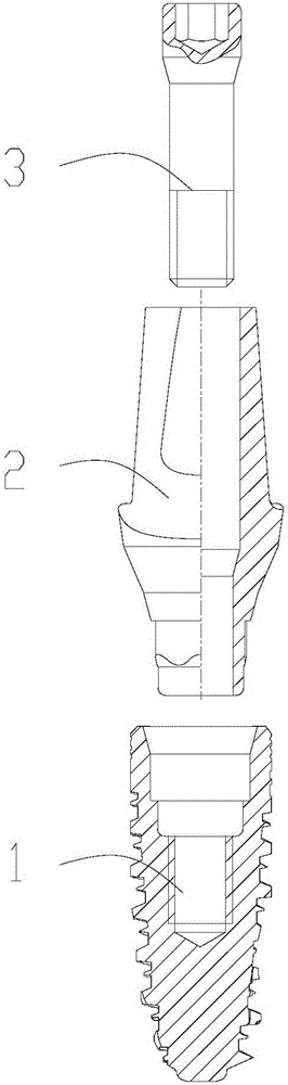 Implant system based on titanium-zirconium alloys