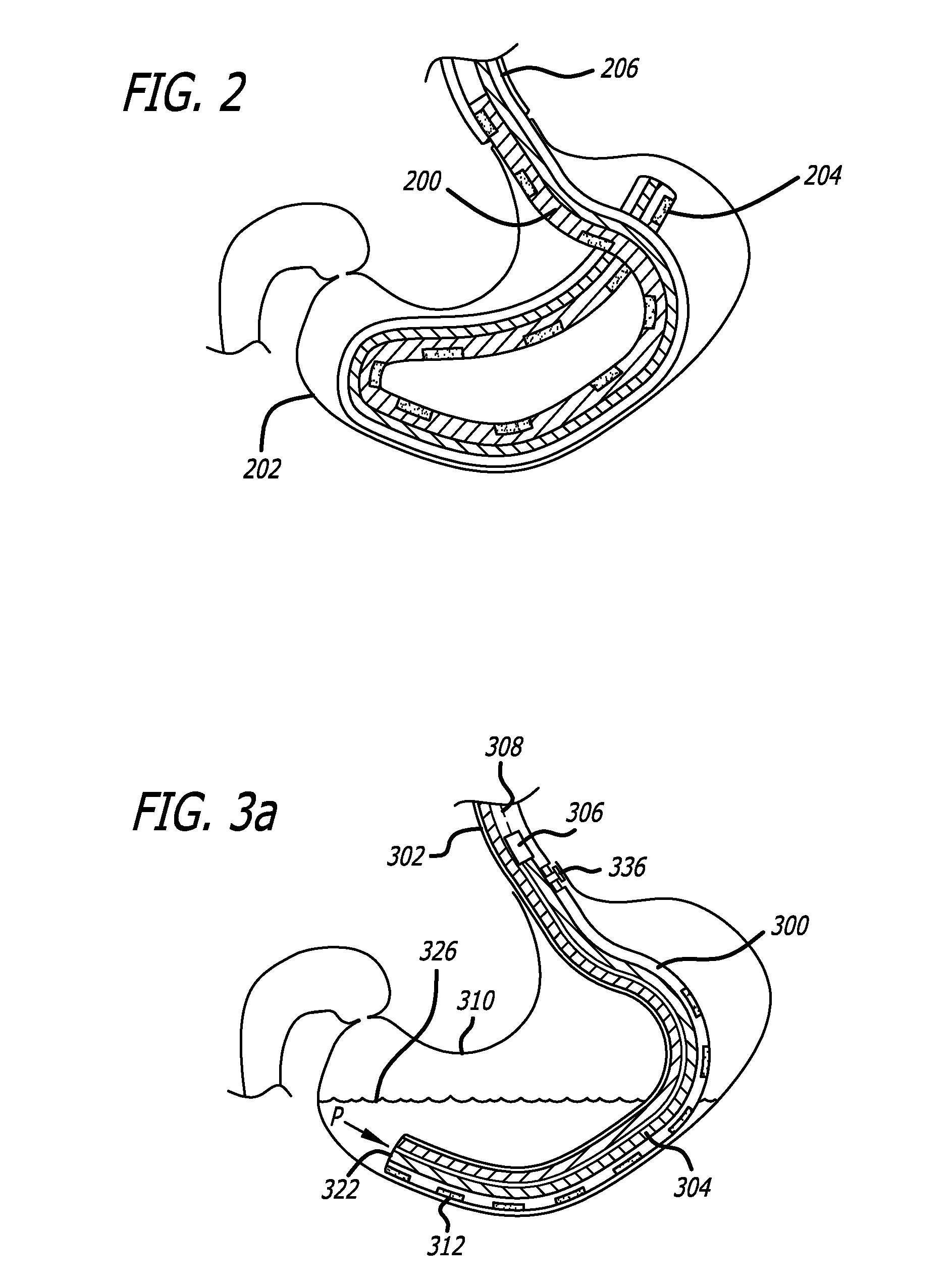 NG tube with gastric volume detection