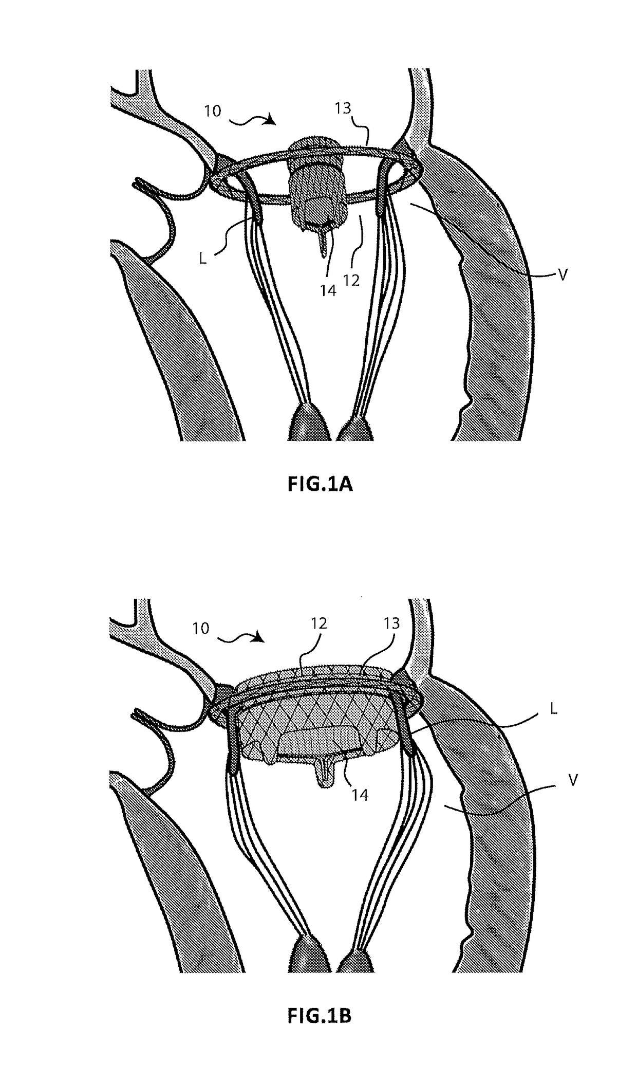 Cardiac valve prosthesis