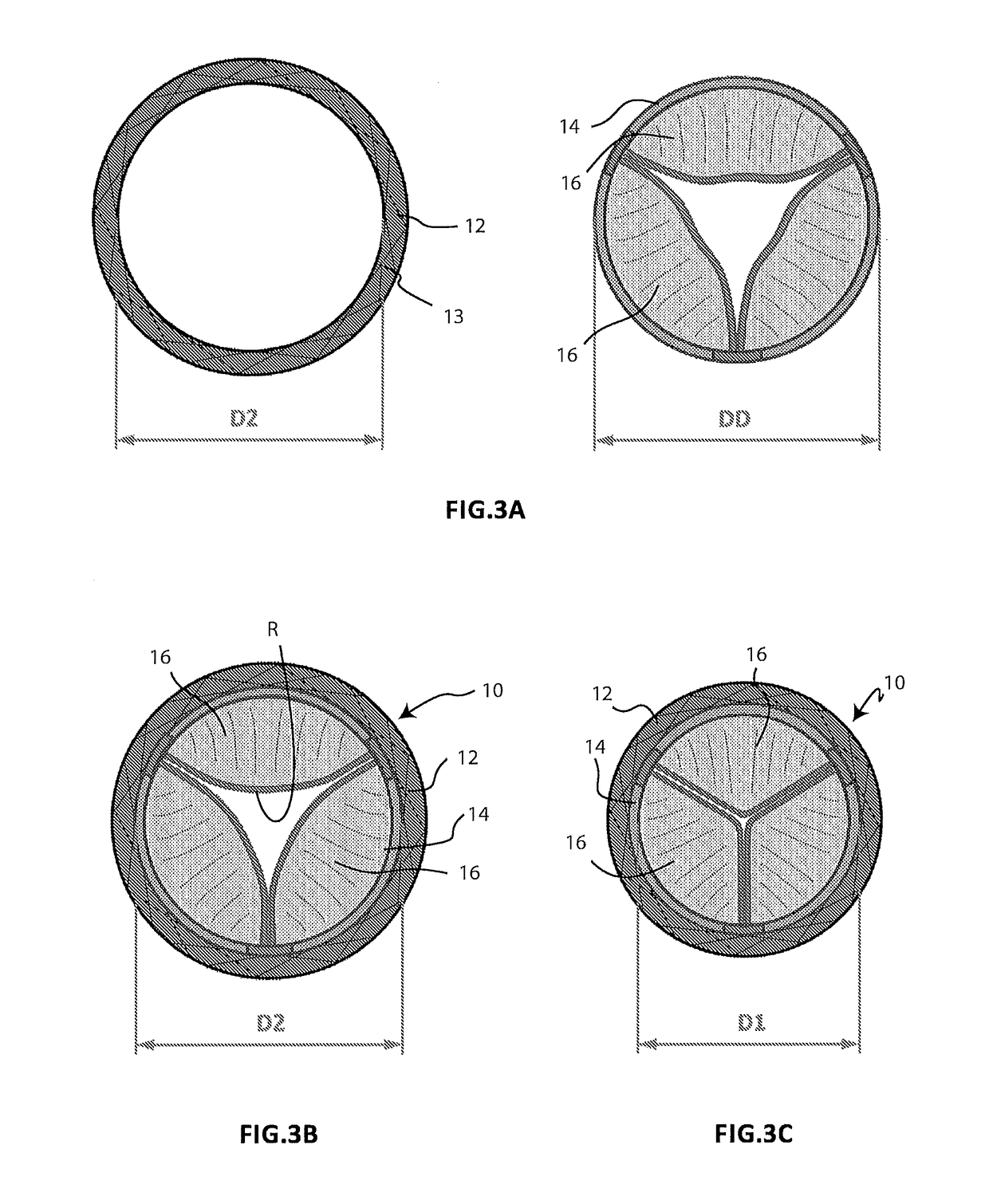 Cardiac valve prosthesis