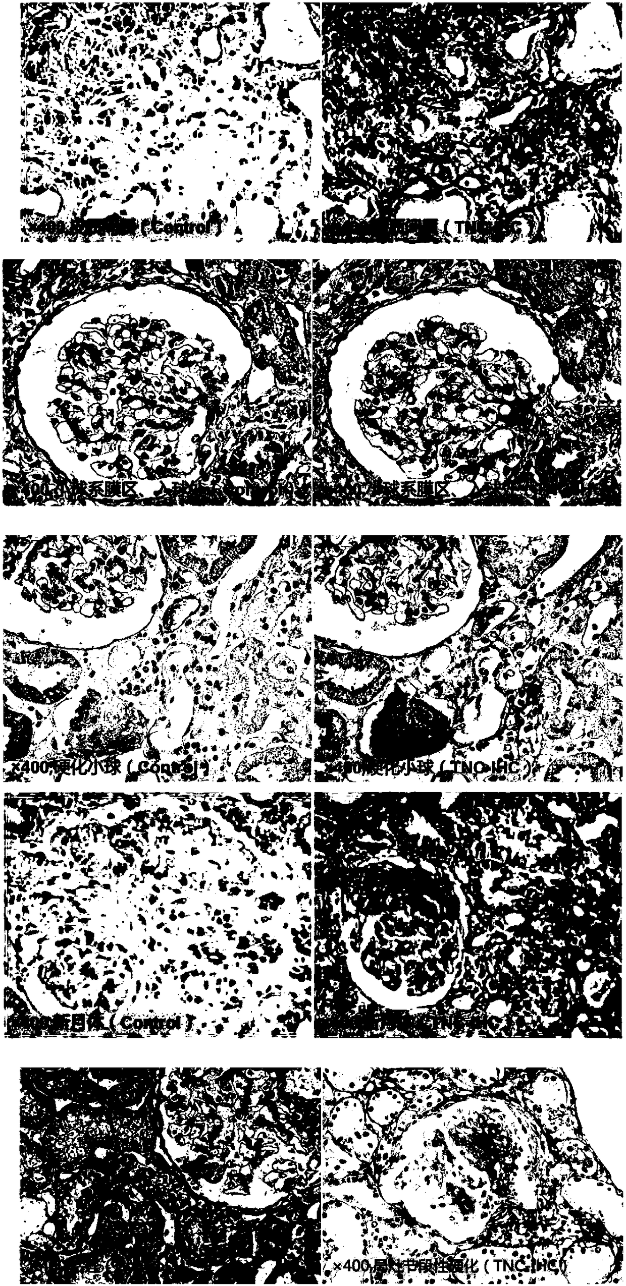 Application of urea Tenascin-C: creatinine in preparing preparation for diagnosing and prognosis evaluating idiopathic IgA nephropathy