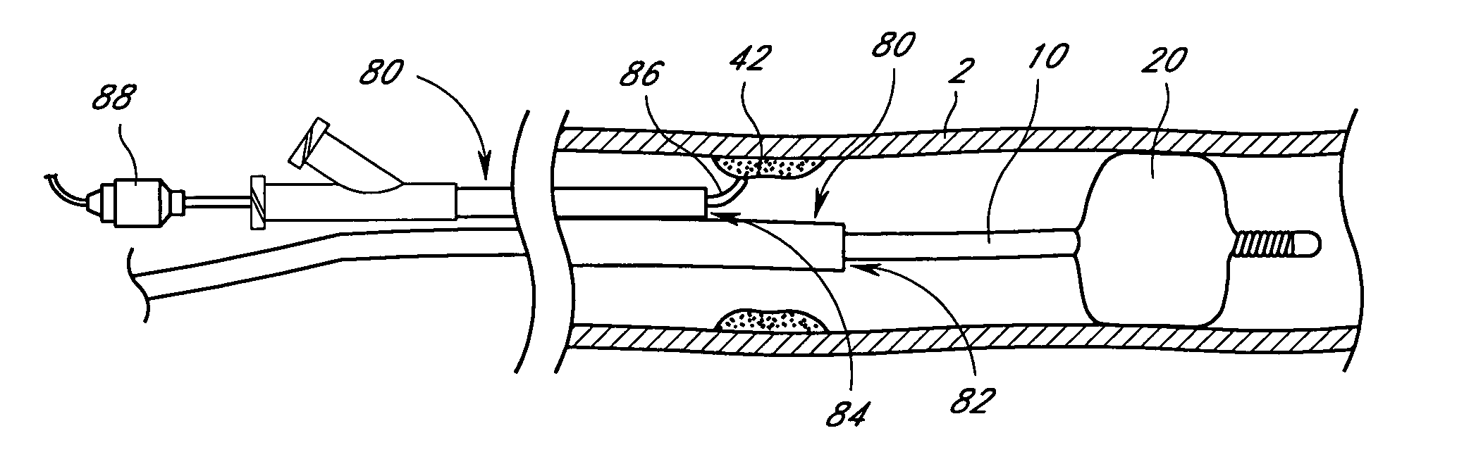 Exchange method for emboli containment